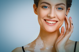 Como tratar o Vitiligo