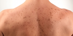 Tratamento para Manchas Corporais