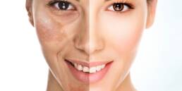 Tratamento para Melasma